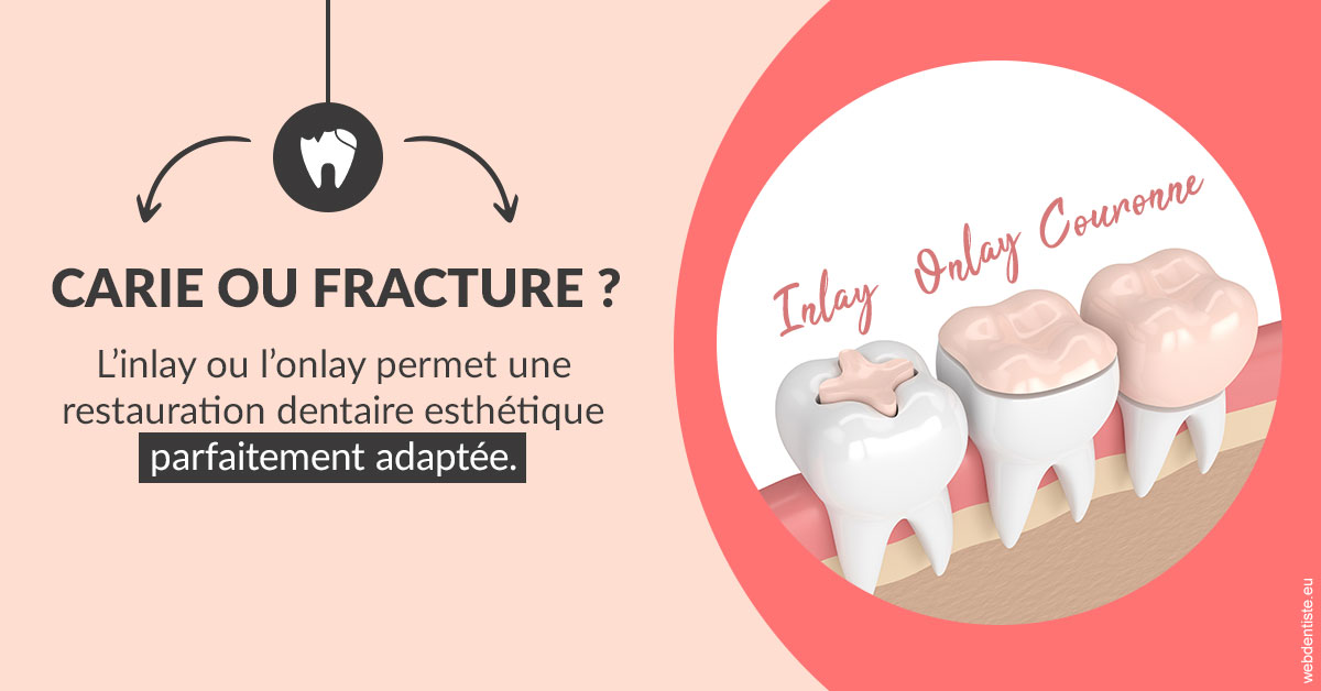 https://dr-bruno-casari.chirurgiens-dentistes.fr/T2 2023 - Carie ou fracture 2