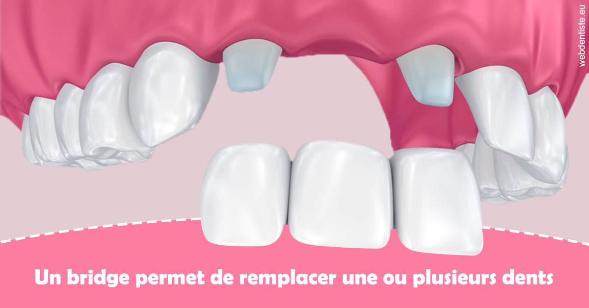 https://dr-bruno-casari.chirurgiens-dentistes.fr/Bridge remplacer dents 2