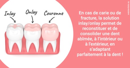 https://dr-bruno-casari.chirurgiens-dentistes.fr/L'INLAY ou l'ONLAY 2