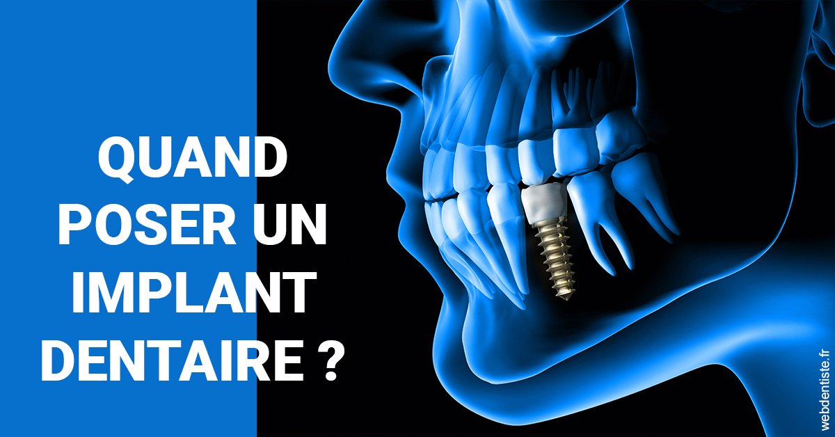 https://dr-bruno-casari.chirurgiens-dentistes.fr/Les implants 1