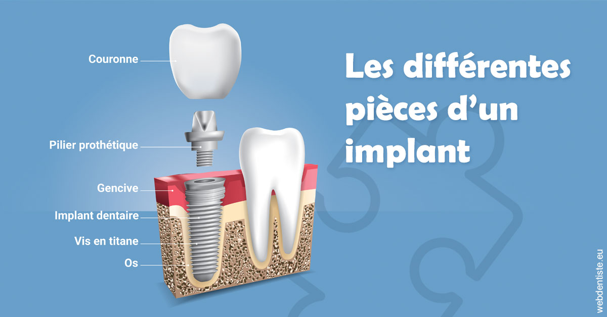 https://dr-bruno-casari.chirurgiens-dentistes.fr/Les différentes pièces d’un implant 1