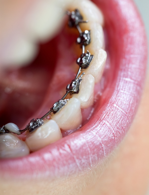 orthodontie linguale